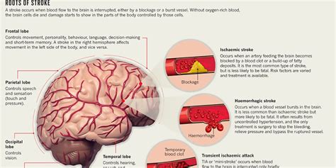 Mini Stroke Symptoms Tia Transient Ischemic Attack Sy