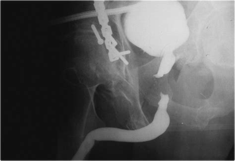 Urethral Stricture Disease Evaluation Of The Male Urethra Journal Of