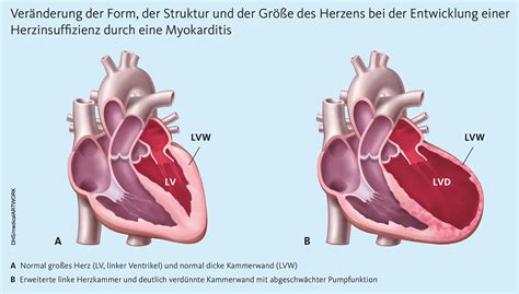 Seit diesem jahr ist bekannt, dass eine herzmuskelentzündung auch nach einer infektion mit dem. Herzmuskelentzündung (Myokarditis) wird bei Kindern häufig übersehen, Deutsche Herzstiftung e.V ...