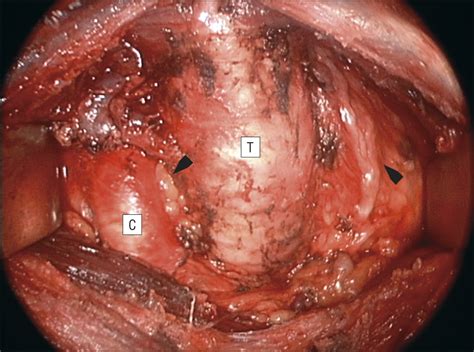 The Importance Of Central Compartment Elective Lymph Node Excision In