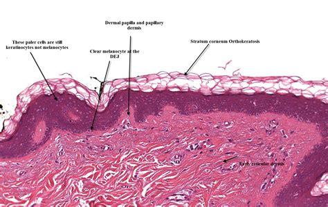 Dermpath Made Simple Neoplastic Introduction To Skin Histopathology