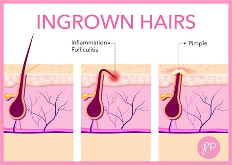 It is a benign condition, which usually appears as a small tan or sometimes pink bump under the skin. Ingrown Hairs - Preventing Future Problems - Charismatic ...