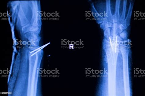 Forearm Orthopedic Implant Xray Scan Stock Photo Download Image Now
