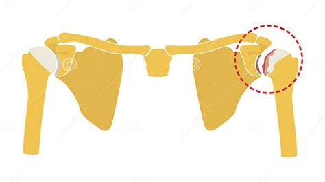 Osteoarthritis Of The Shoulder Joint Degeneration Of Joint Cartilage