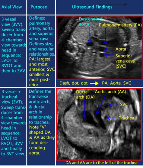 Normal Fetal Heart Ultrasound Ob Images Artofit