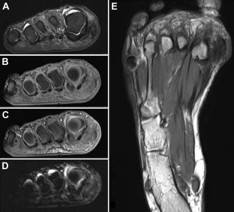 Mri of the soft tissues of the foot visualizes the fat cushions of the sole, heels, fingers and can show swelling, foci of infiltration and inflammation. MRI appearance of surfers' knot medial to the patients ...