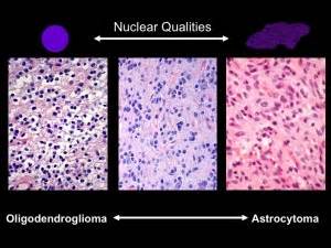 This short video features young cancer patients talking about cancer from their. microscope slides | Lab Land
