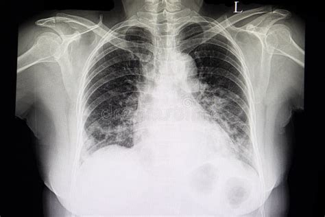 A Chest Xray Film Of Patient With Heart Failure Stock Photo Image Of
