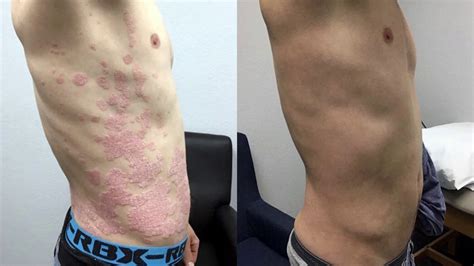 Psoriasis Treatment With Before And After Photos Youtube
