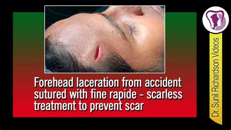 Forehead Laceration From Accident Sutured With Fine Rapide Scarless