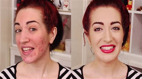 How To Cover Acne And Scars Easy Makeup Transformation For Pimples