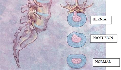 ¿que Es Una Hernia Discal Y Como Se Trata Buenaforma