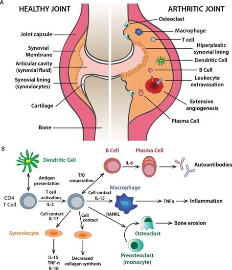 Rheumatoid Arthritis