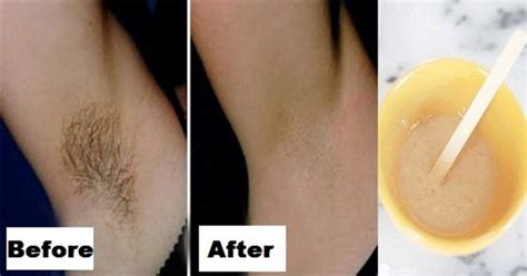 You Only Need 2 Ingredients And 2 Minutes To Get Rid Of Underarm Hair Forever Underarm Hair