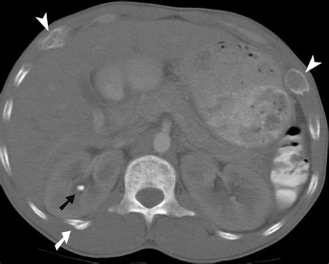 Primary Hyperparathyroidism Due To Parathyroid Adenoma Radiographics