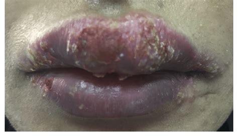 Yellow Crust Around Lips