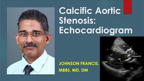 Calcific Aortic Stenosis Echocardiogram Youtube