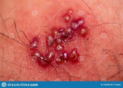 Skin Rash And Blisters On Body Shingles On Men Herpes Zoster Stock