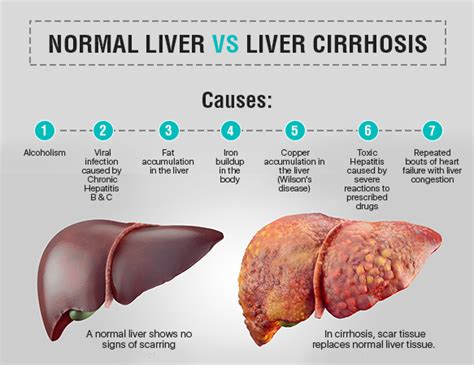 Discover the causes of cirrhosis, diagnosis, prevention, and how to. Liver Cirrhosis Treatment Cost in India - AILBS