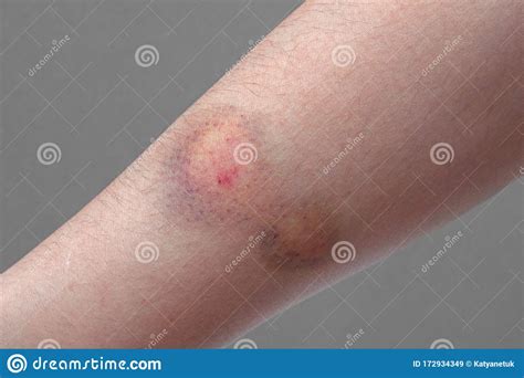 Close Up Of A Colored Bruise On A Woman Arm Stock Image Image Of