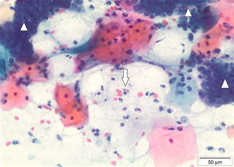 Candida Albicans Infection Of Cervix And Comparison Of Pap Smear And