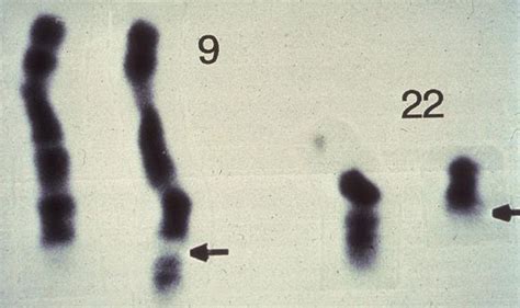 Science Types The Philadelphia Chromosome By Jessica Wapner A Story