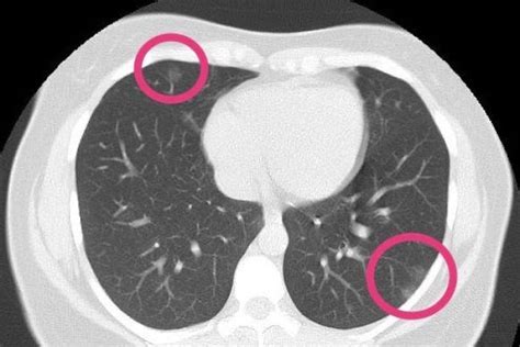 Chest Ct Scan Finds Coronavirus Pneumonia In Lung Of Healthy Woman 30