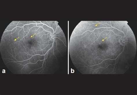 Figure 5diabetic Papillopathy With Macular Edema Treated With