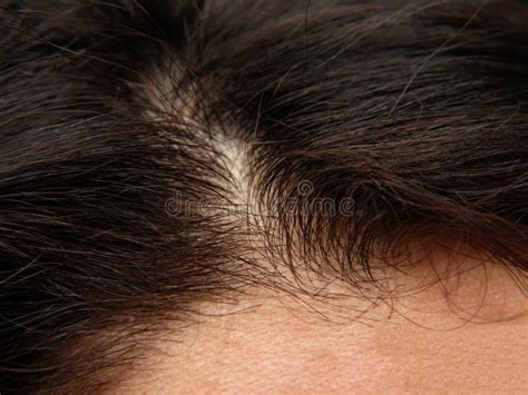 Dry Itchy Dandruff Scalp With Scabs On Woman S Head With Hair Stock