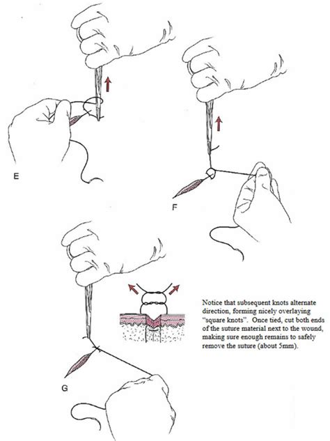 Surgical Suture Types Of Sutures Sizes How To Suture And Suture