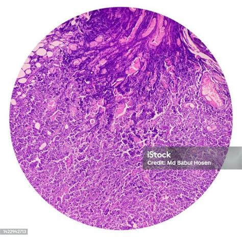 Supraclavicular Lymph Node Biopsy Microscopic Image Showing Benign