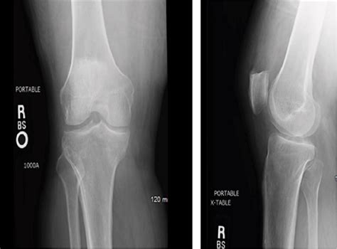 Gouty Arthritis Knee Mri Gout Healer