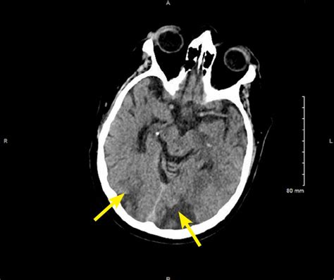 Posterior Reversible Encephalopathy Syndrome Cleveland Clinic Journal