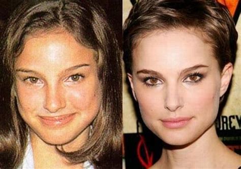 Stars Before And After Plastic Surgery 47 Pics