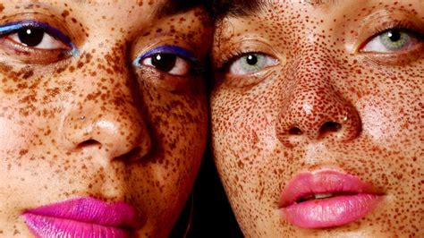 What Causes Freckles Heres How They Form