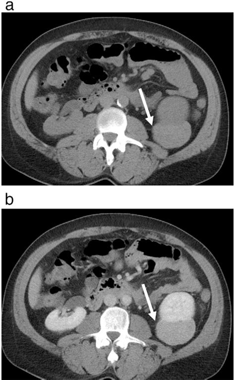 Figure 1 From Characterization Of Renal Cell Carcinoma Oncocytoma And