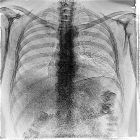 The costal angle also marks the attachment for some of the deep back muscles to. Rib Cage Labeled Posterior View - Rib Cage Posterior View ...
