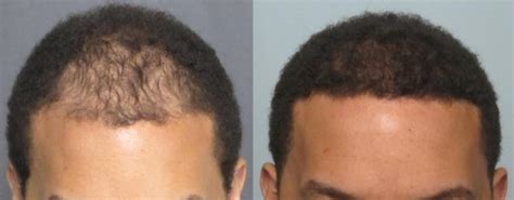 The most stressful thing for our patient was how. Hairline Transplant Grafts | Dr. Sean Behnam (310) 829-4291