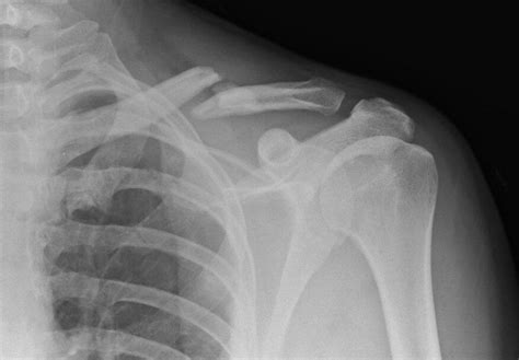 Fractured Collarbone Surgery Surgery For Clavicle Fracture Broken