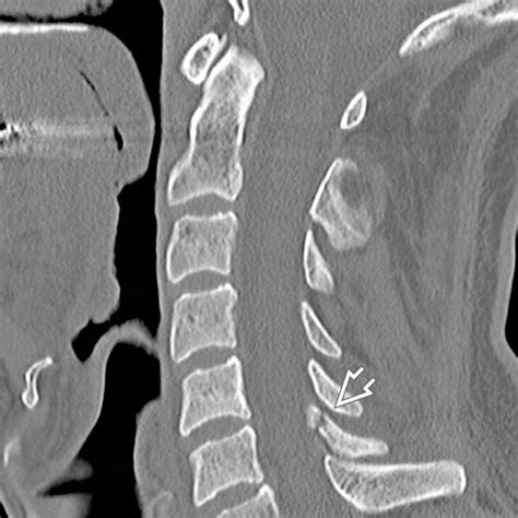 Cervical Hyperextension Rotation Injury Radiology Key