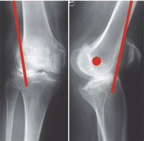 Genu Recurvatum In Total Knee Arthroplasty Musculoskeletal Key