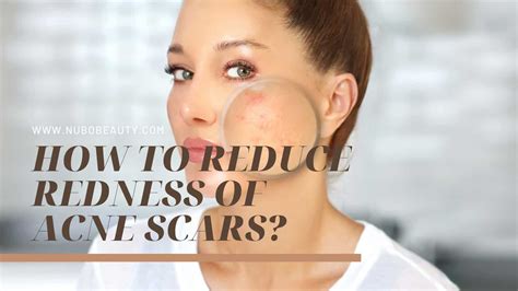 How To Reduce Redness Of Acne Scars Nubo Beauty