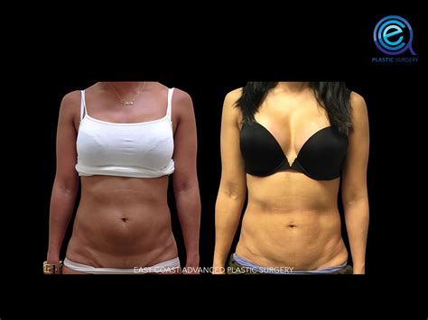 Abdominoplasty Tummy Tuck Before And After Photos Plastic Surgery