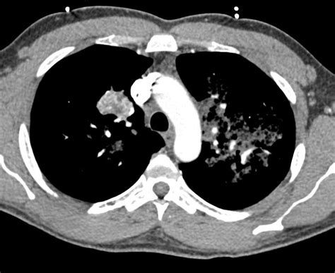 Pulmonary Hemorrhage Best Seen In The Left Lung Chest Case Studies