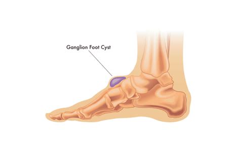How To Deal With A Ganglion Cyst Feet By Pody