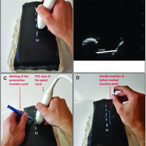 Pdf Ultrasound Guided Lumbar Puncture With A Needle Guidance System