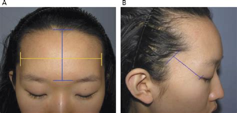 Figure 3 From Classification Of The Female Hairline And Refined Hairline Correction Techniques