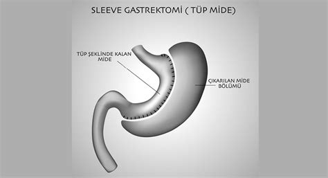 T P Mide Ameliyat Sleeve Gastrektomi Ota Jinemed Hastanesi