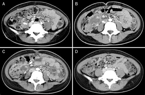 Abdominal Ct Findings A About 1 Cm Sized Lymphadenopathy With