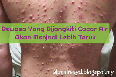The name, chicken pox is vernacular for the varicella zoster virus. A Healthy Living: Orang Dewasa Yang Belum Dijangkiti ...